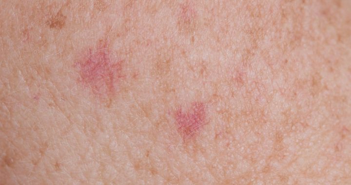 Hautsymptome und ganzheitliche Heilung: Ursachen und natürliche Behandlungsansätze